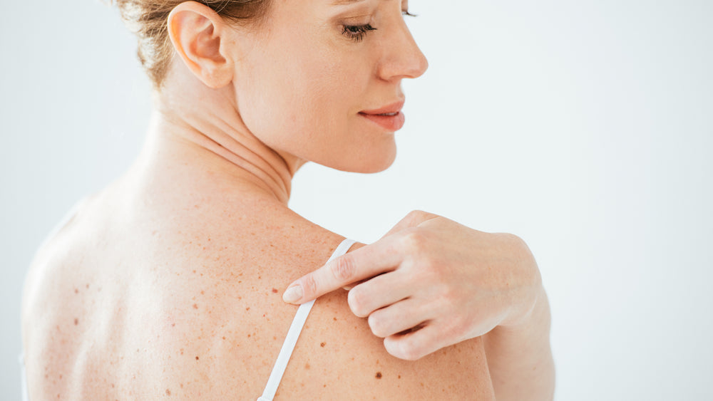 What’s the difference between a Mole and a Dark Spot?